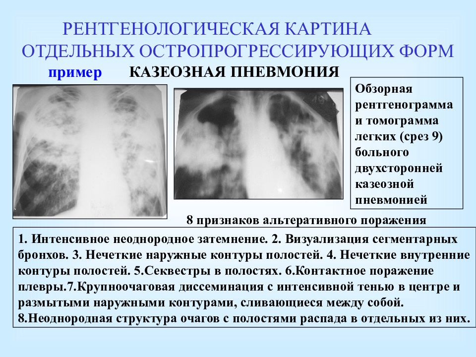 Возможные варианты развития клинической картины при туберкулезе легких