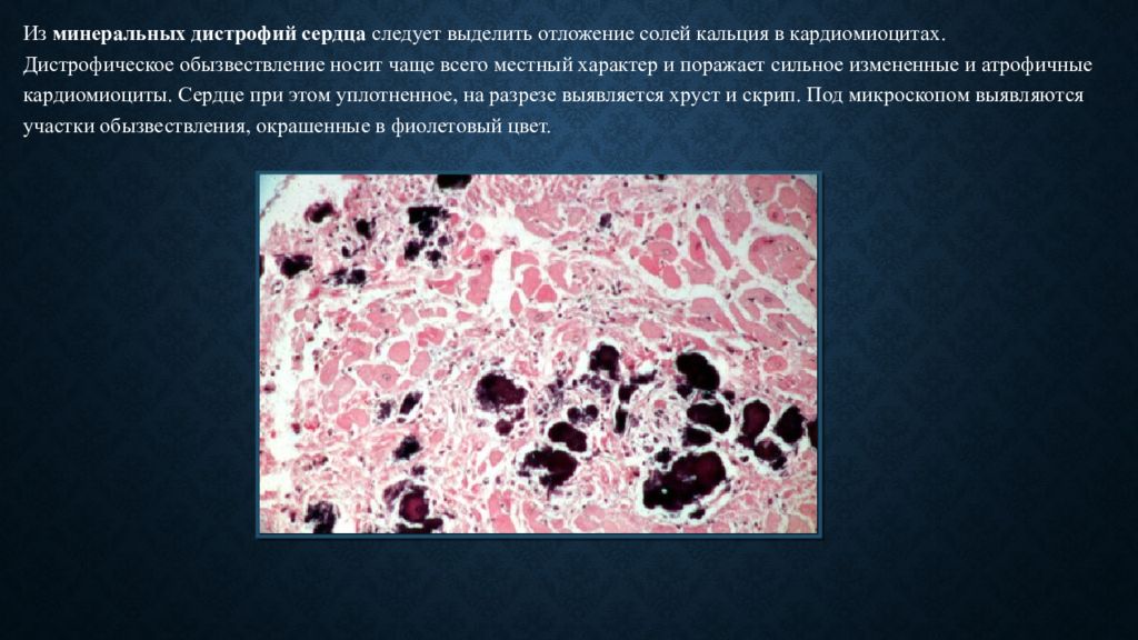 Обызвествление это. Кальциноз сосудов патанатомия. Дистрофическое обызвествление. Заболевания крови патанатомия. Кальциноз патологическая анатомия.