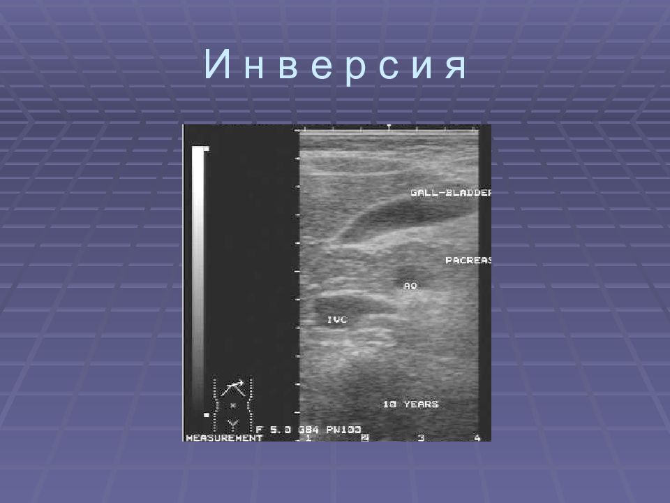 Узи с водной нагрузкой. УЗИ презентация. УЗИ сб. Воздух на УЗИ. Мифы об УЗИ.