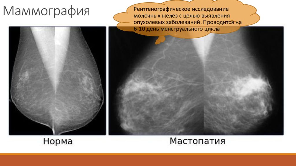 Маммография фкм. Кистозно фиброзная мастопатия на маммографии. Фиброзно-кистозная мастопатия рентген молочных желез. Мастопатия молочной железы маммограмма. Фиброзно-кистозная мастопатия молочных желез на маммографии.