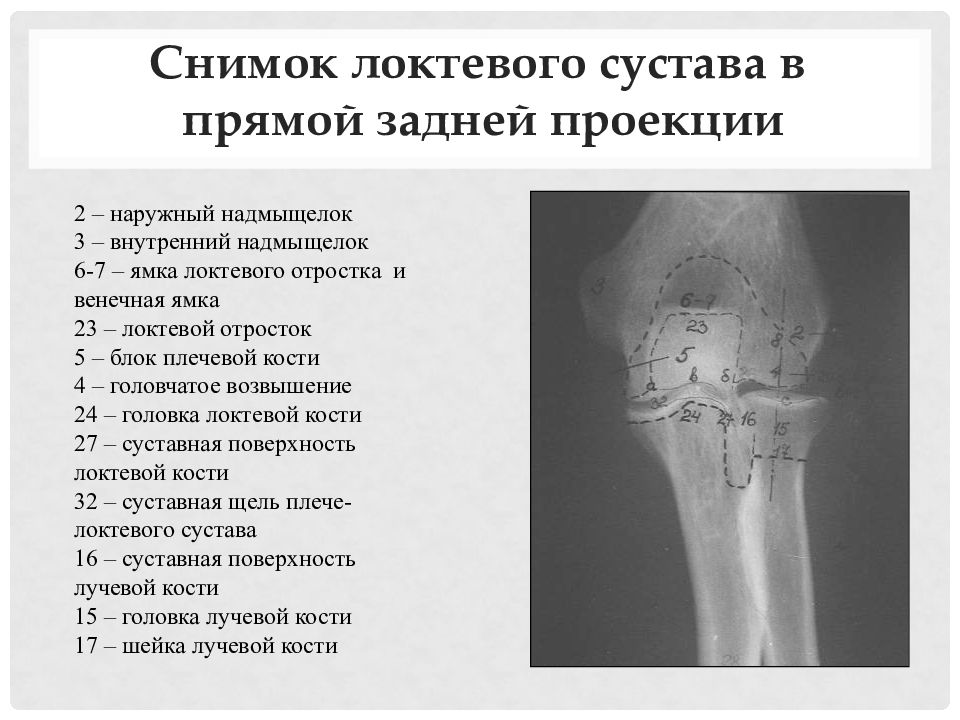 Левый локтевой сустав. Локтевой сустав рентген Королюк. Локтевой сустав рентген анатомия. Рентгеноанатомия локтевого сустава у детей. Рентген локтевого сустава в прямой проекции.