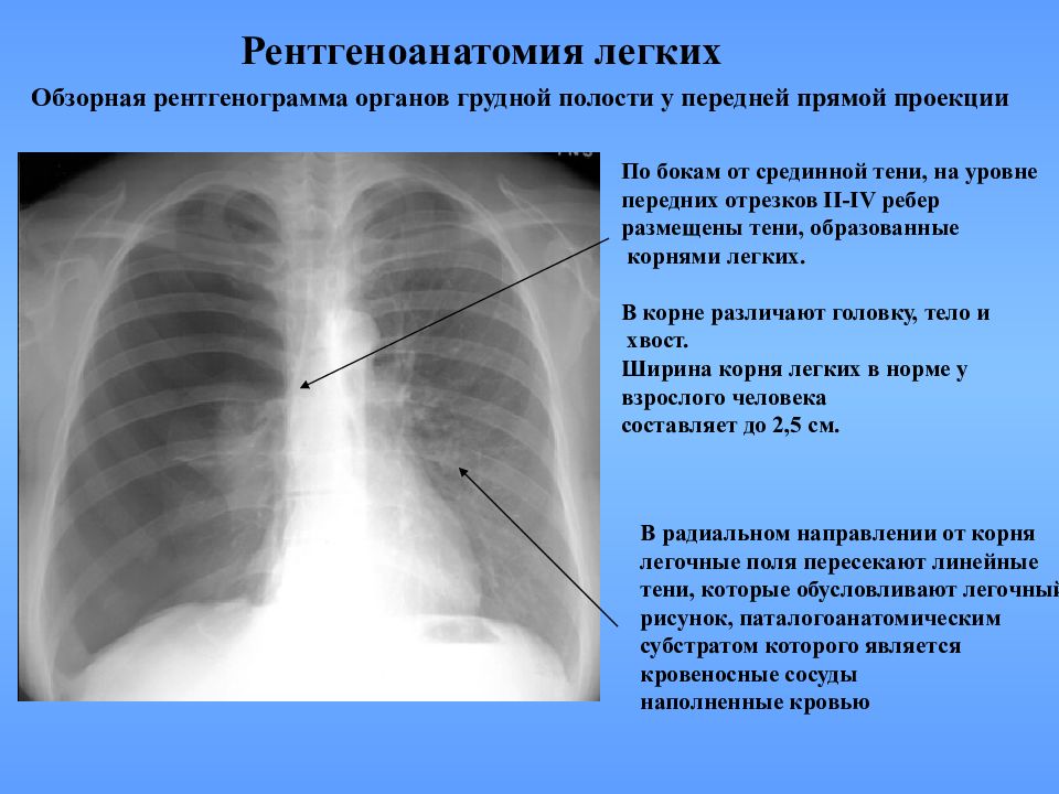 Кардиодиафрагмальный синус. Передняя проекция грудной клетки рентген. Обзорная рентгенография грудной клетки. Тень ЦВК на рентгене легких. Рентген органов грудной клетки норма.