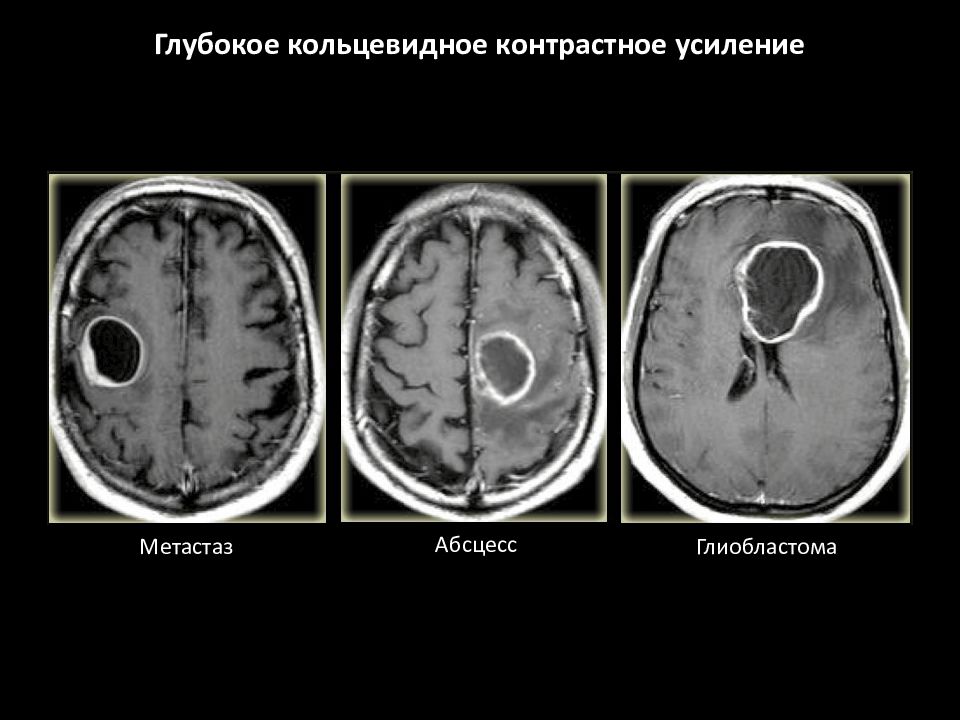 Контраст перед мрт. Кт с контрастным усилением. Контрастное усиление. Контрастное усиление при кт. Контрастное усиление при мрт.