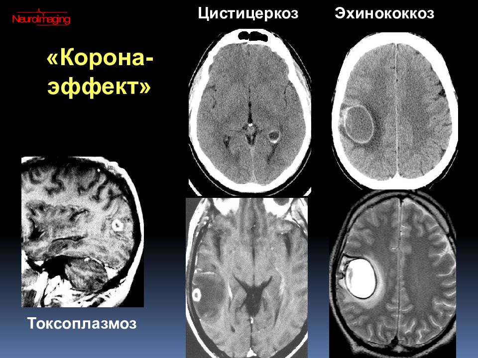 Токсоплазмоз головного мозга кт картина