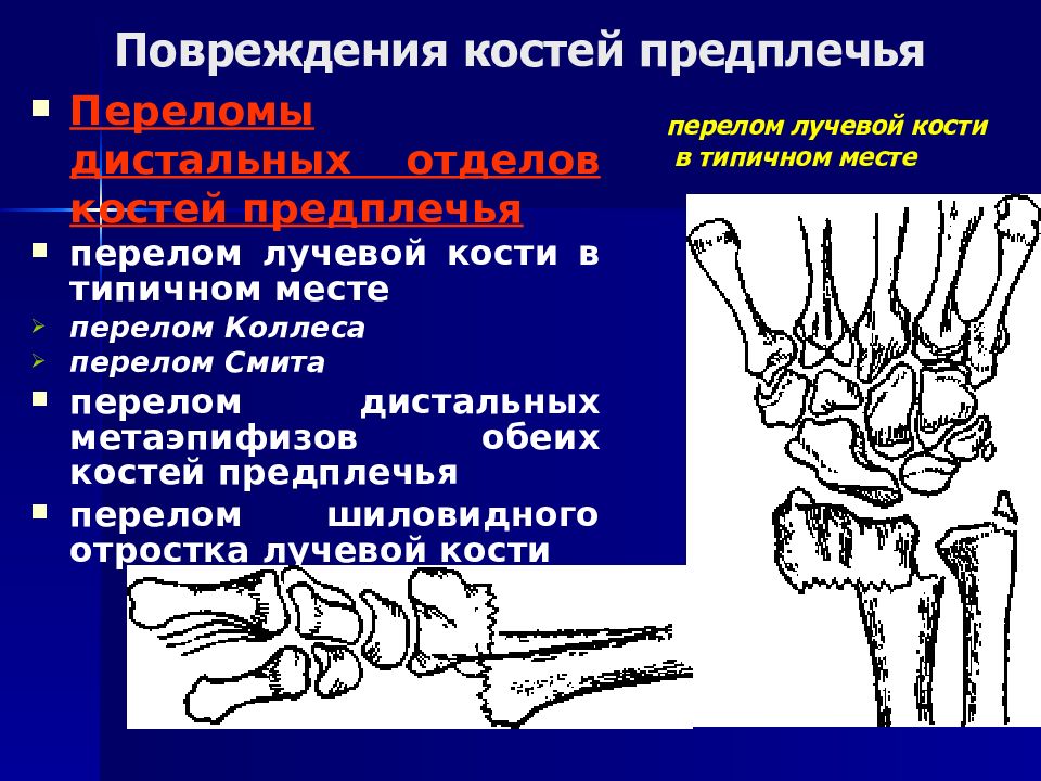 Закрытый перелом предплечья карта вызова смп