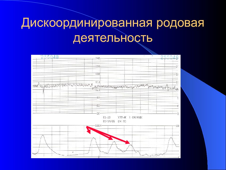 Родовая деятельность. Дискоординированная родовая деятельность партограмма. Партограмма дискоординации родовой деятельности. Дискоординация родовой деятельности по КТГ. КТГ при дискоординации родовой деятельности.