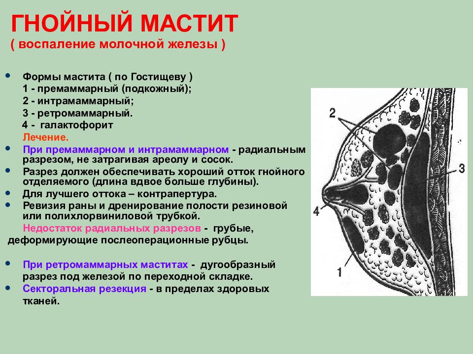 1 молочная железа. Ретромаммарный Гнойный мастит. Субареолярный Гнойный мастит. Топографическая анатомия и Оперативная хирургия молочной железы. Гнойный мастит радиальный разрез.