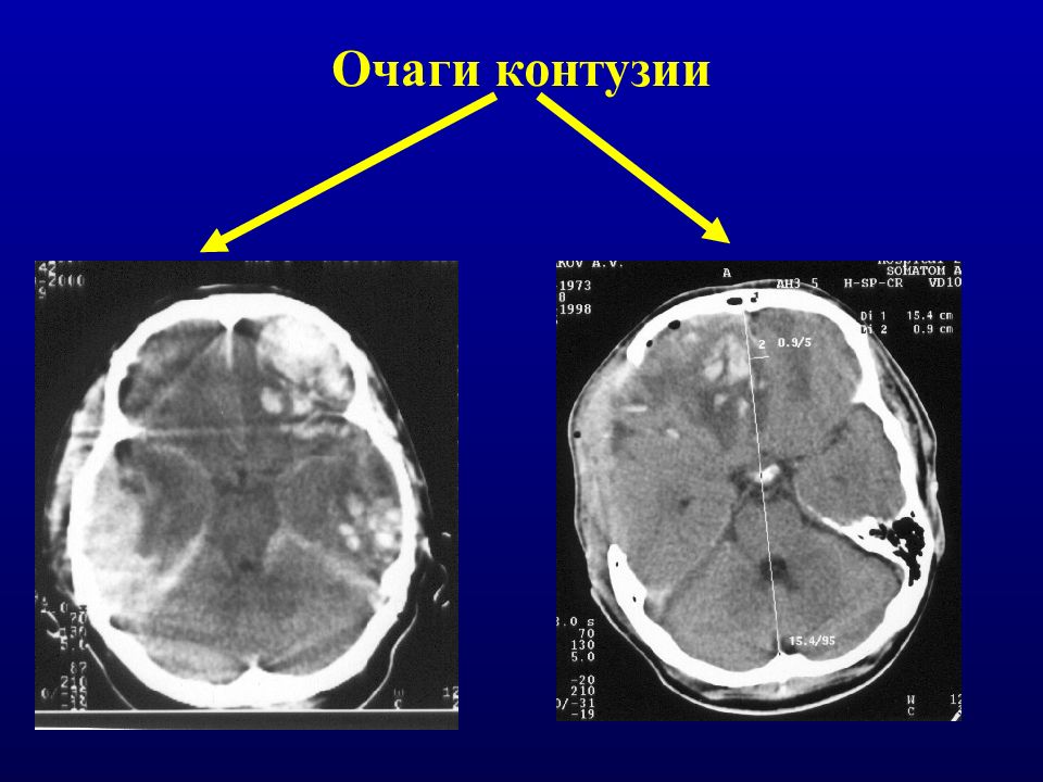 Что такое контузия. Контузионные очаги головного мозга. Контузионный очаг в головном мозге.