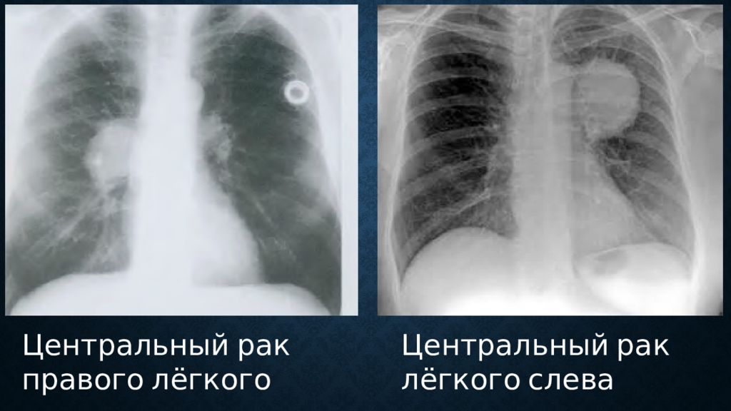 Признаки центрального рака легкого. Центральная опухоль легкого. Опухоль правого легкого. Центральная опухоль правого легкого. Опухоль легкого на рентгене.