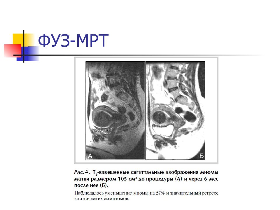 Миома матки мрт картина