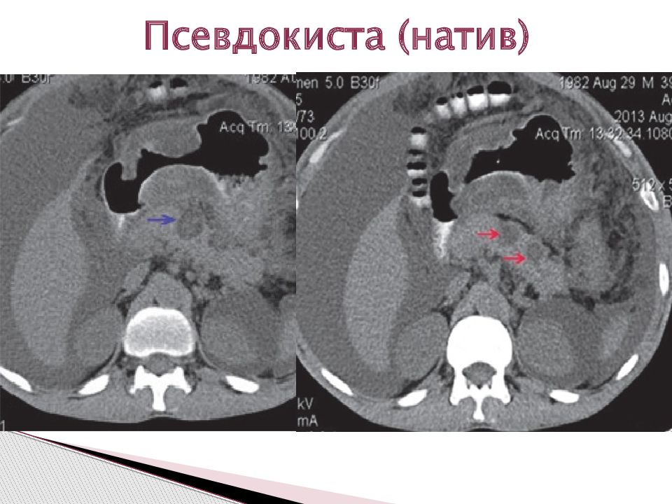 Псевдокиста поджелудочной железы. Псевдокисты поджелудочной железы на кт. Псевдокиста поджелудочной железы мрт. Псевдокиста поджелудочной железы кт. Псевдокиста головки поджелудочной железы на кт.