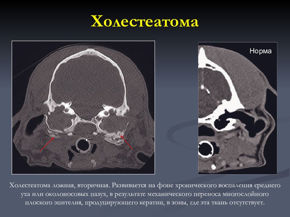 Средний отит кт картина