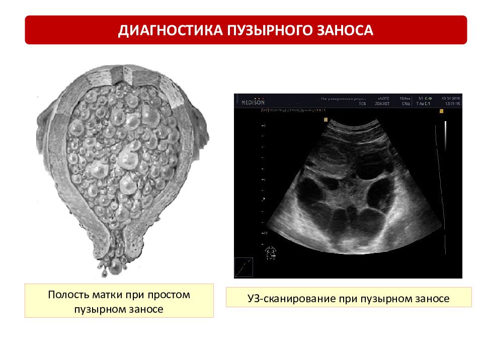 Пузырный занос картинки узи