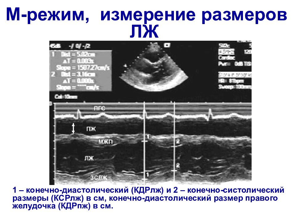 Эхокардиография сердца презентация