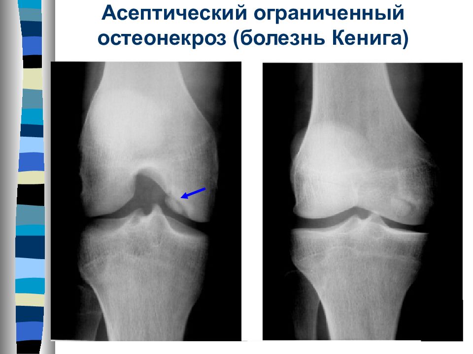 Хондромаляция мыщелка бедренной. Остеохондропатия Кенига. Остеохондрит коленного сустава рентген. Остеонекроз коленного сустава рентген. Асептический некроз мыщелка бедренной кости кт.