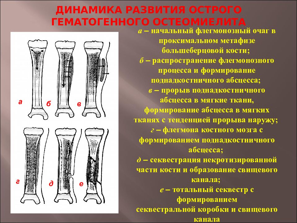 Лечение остеомиелита презентация