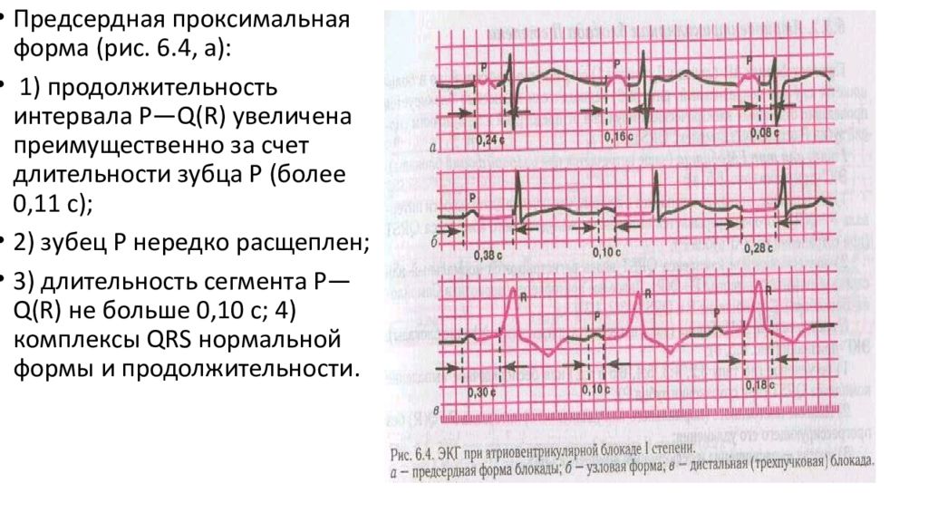 Как действует блокада. Предсердный ритм с АВ блокадой 1 степени. Проксимальная форма АВ блокады 3 степени ЭКГ. АВ блокада 1 степени предсердная форма. Предсердная тахикардия с АВ блокадой 1 степени.