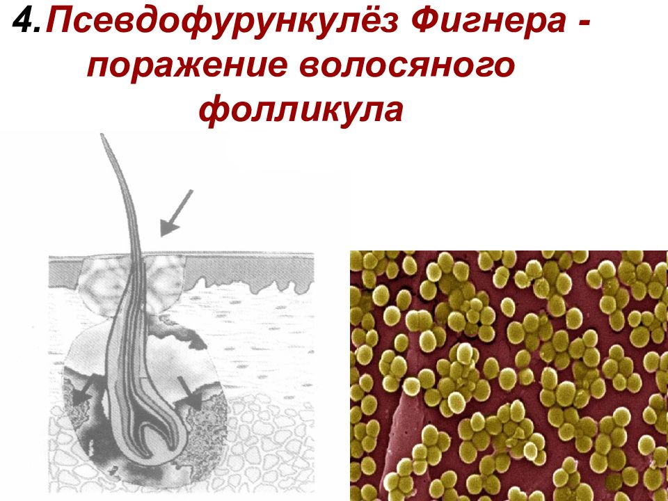 Псевдофурункулеза клиническая картина