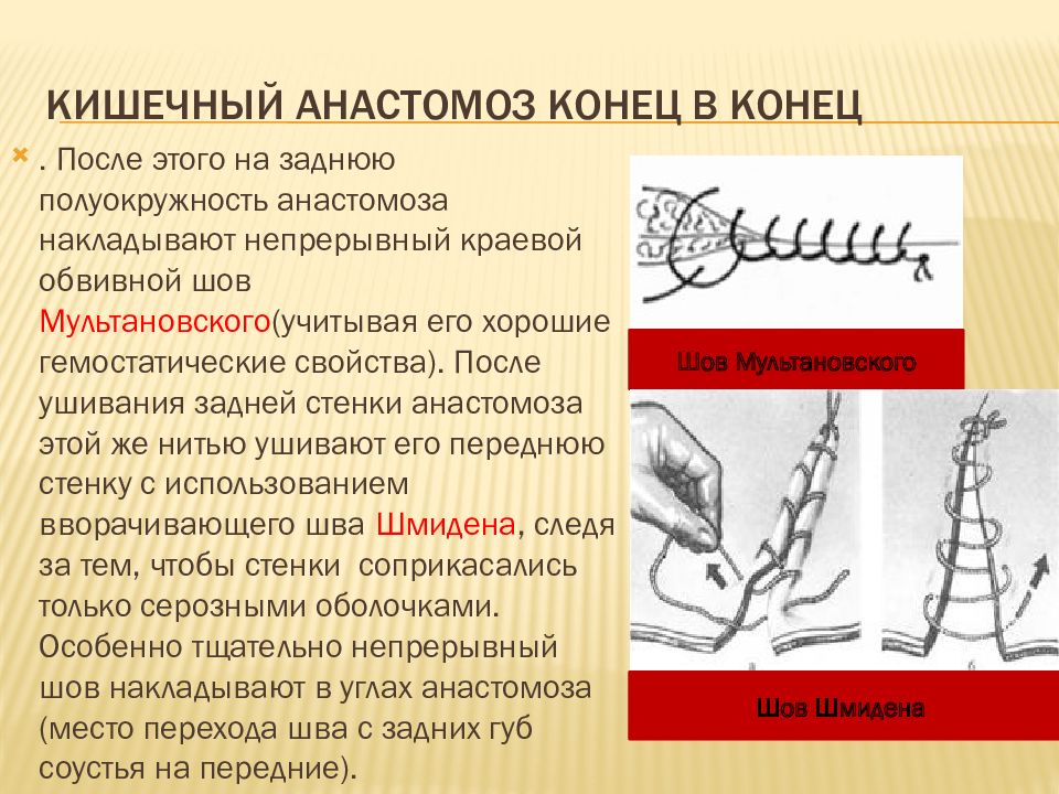 Анастомоз конец в конец схема