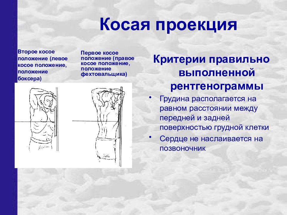 В боковой проекции изображение грудной клетки правильно соориентированного пациента характеризуется