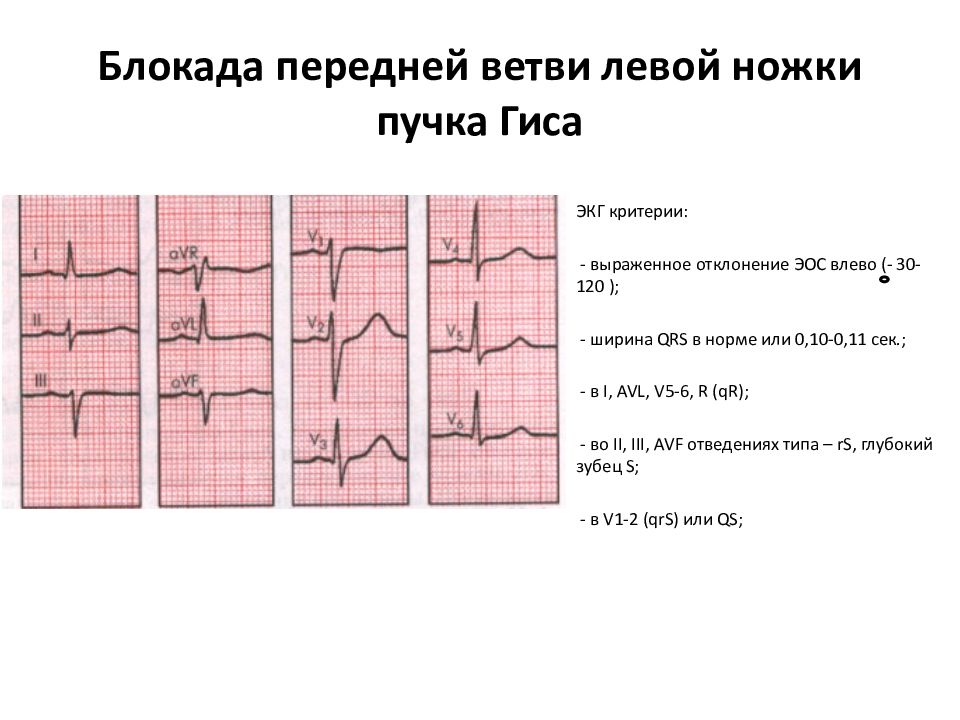 Блокада левого переднего пучка гиса. Блокада левой передней ножки пучка Гиса на ЭКГ. Блокада ветвей ножек пучка Гиса на ЭКГ. Блокада левой задней ветви на ЭКГ. Блокада передней ветви левой ножки пучка Гиса на ЭКГ.