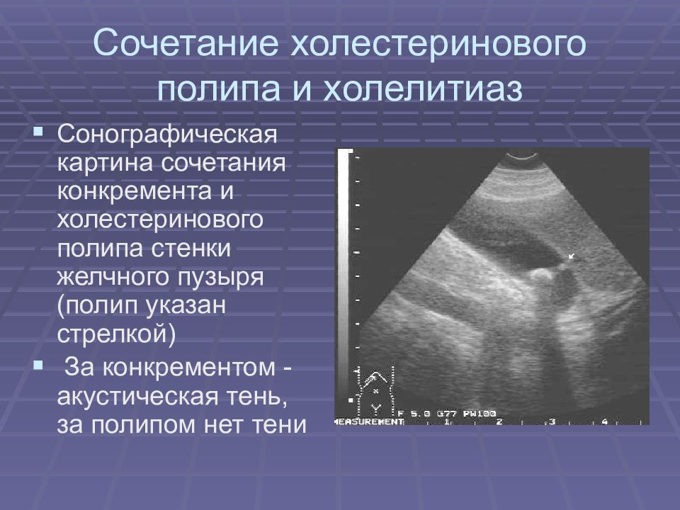 Полипы в желчном пузыре что. Холестериновый полип желчного пузыря кт. Полип желчного пузыря на УЗИ. Холестериновый полип на УЗИ. Холестериновый полип желчного пузыря на УЗИ.