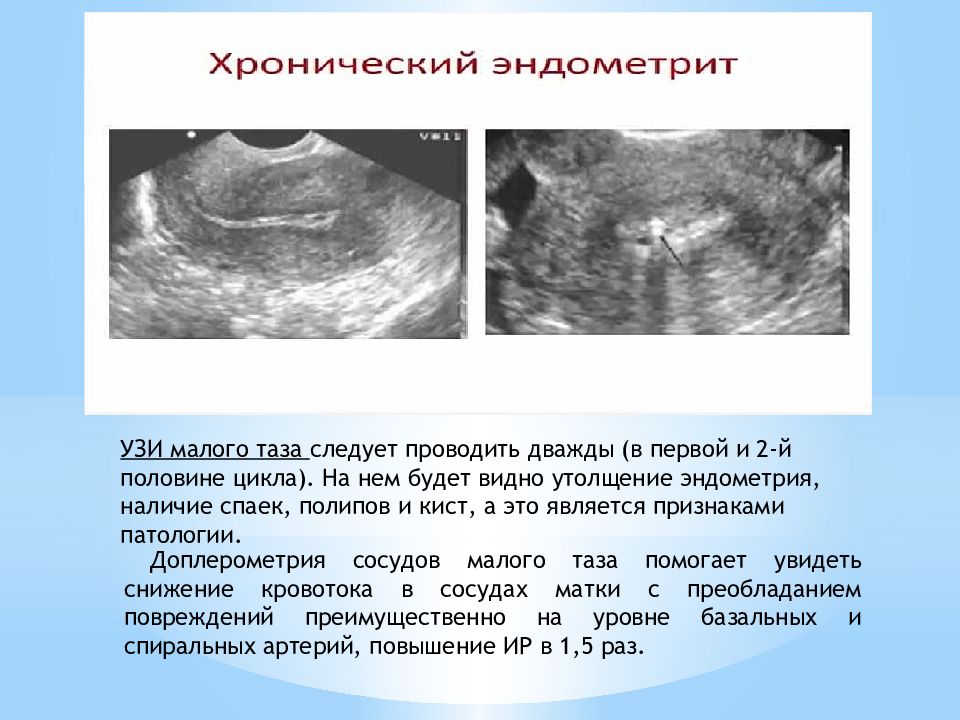 Морфологическая картина хронического эндометрита