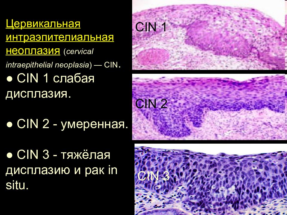 Интраэпителиальное поражение