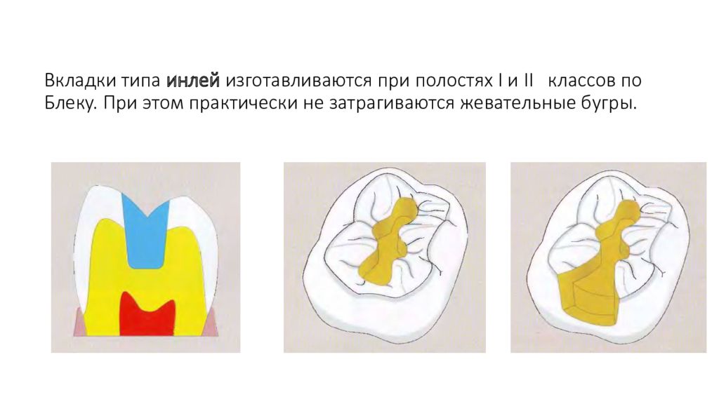 2 полости. Препарирование под вкладку Инлей. Вкладки Инлей онлей оверлей пинлей. Препарирование полости под вкладку Инлей.