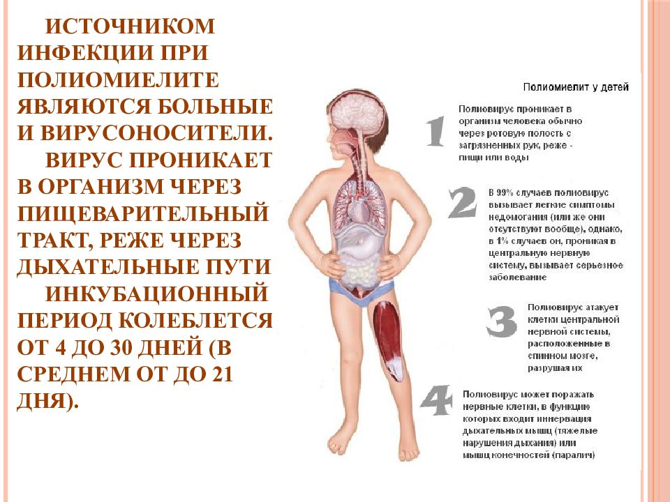 Полиомиелит это что за болезнь фото