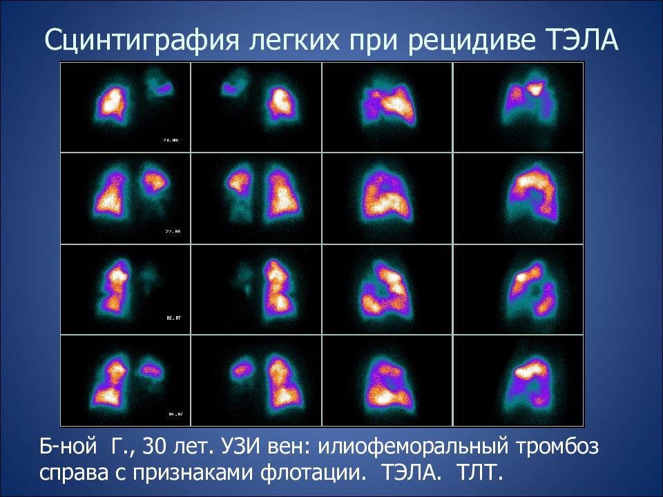 Что такое сцинтиграфия