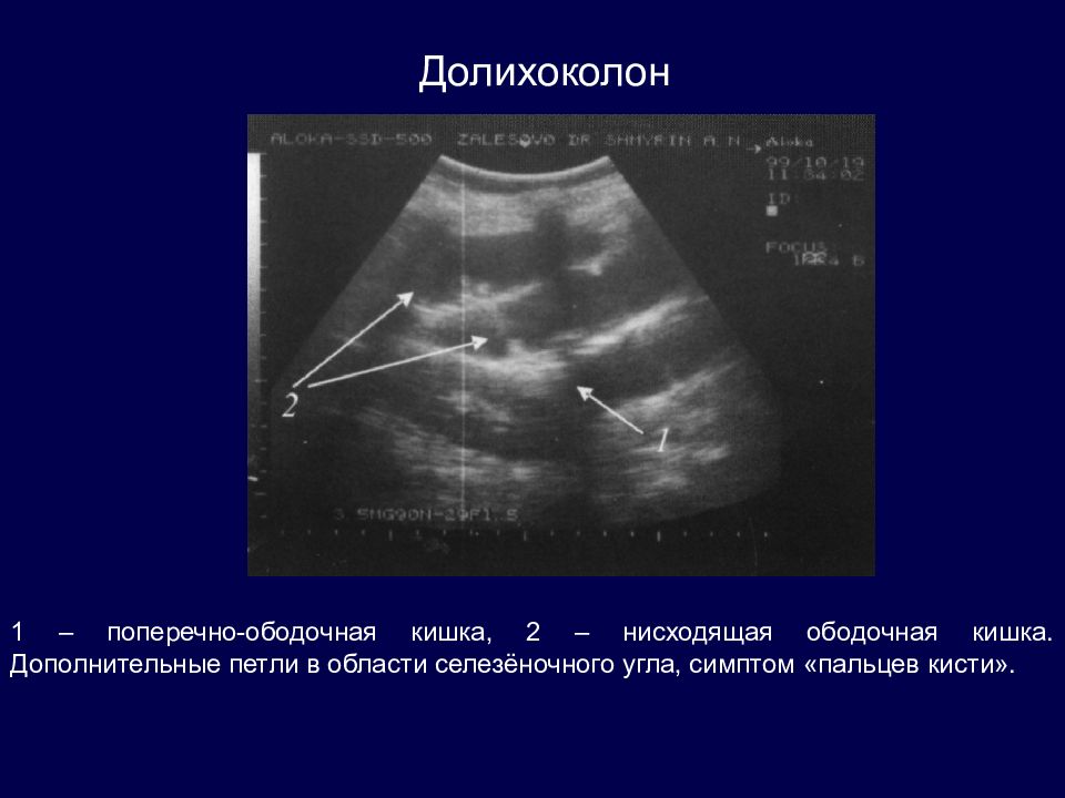 Долихосигма кишечника что. Долихоколон ободочной кишки. Долихоколон и петли кишечника. Долихоколон поперечно ободочной кишки. Дополнительная петля в кишечнике.