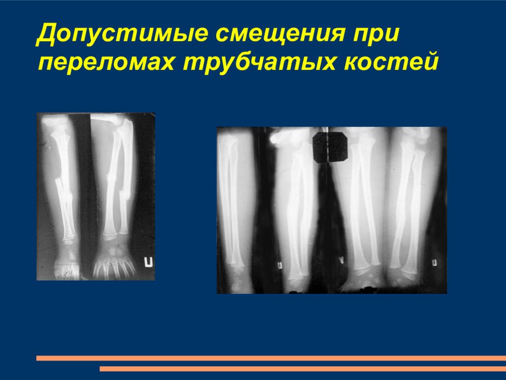 смещение отломков трубчатых костей. перелом дистальная метаэпифища лучевой кости. дистальный метаэпифиз лучевой кости перелом рентген. дистальный перелом лучевой кости. лучевая кость смещение допустимое.