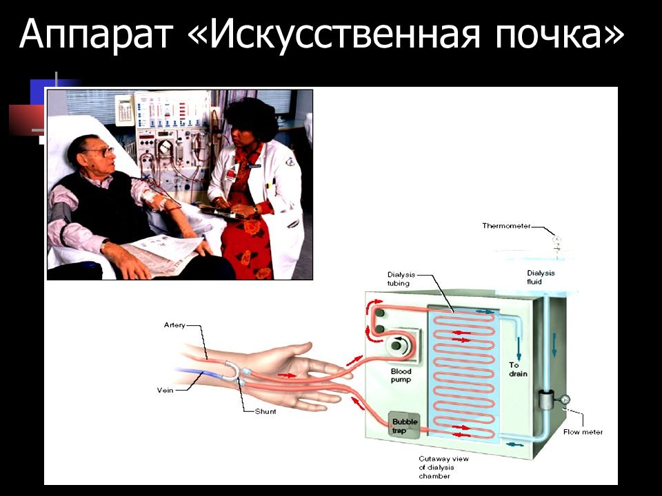 Искусственная почка презентация