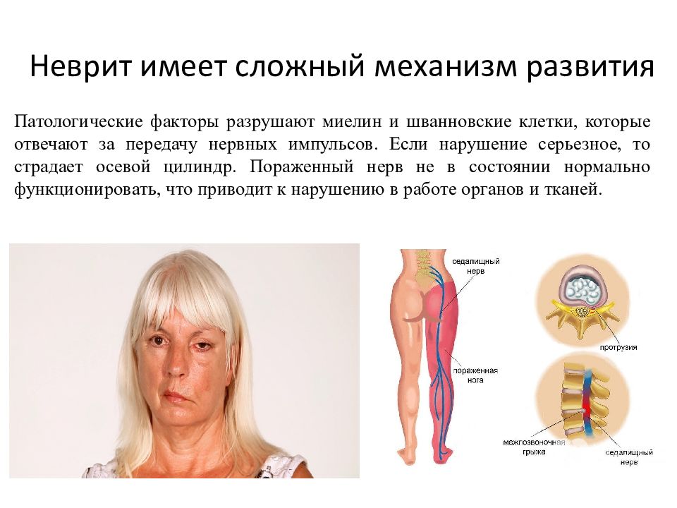 Неврит. Невриты. Неврит примеры. Невриты актуальность.