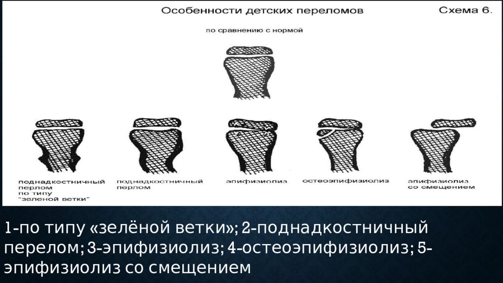 Особенности переломов костей