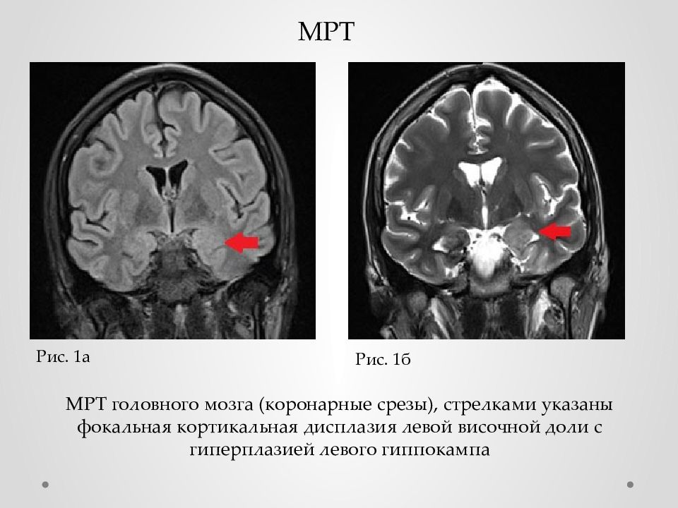 Мезиальный темпоральный склероз. Фокальная кортикальная дисплазия мрт. Фокальная кортикальная дисплазия височной доли мрт. Фокальная корковая дисплазия мрт. Фокальная эпилепсия мрт.