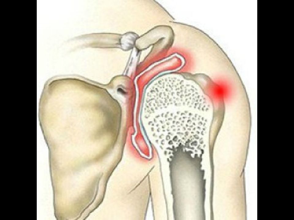 Артрит плечевого сустава симптомы