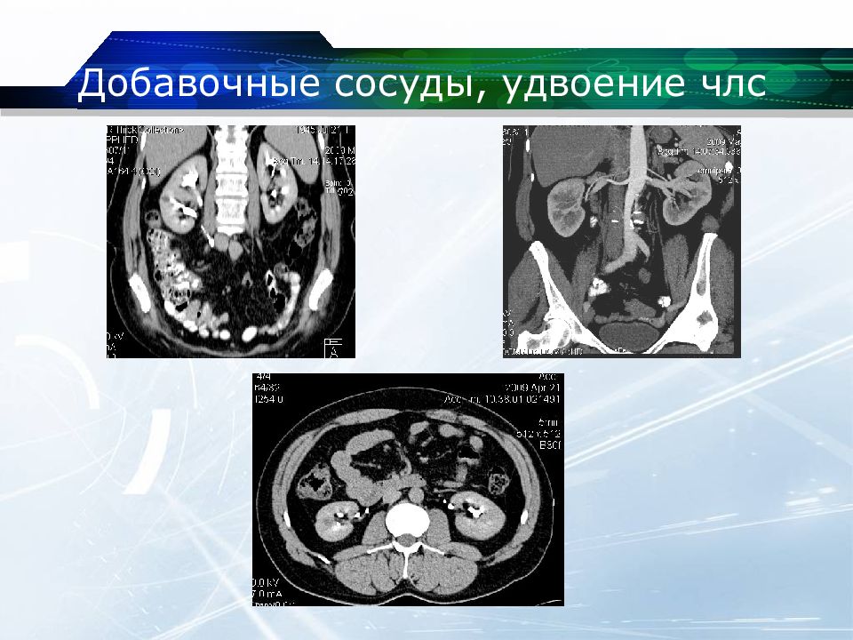 Кт почек презентация