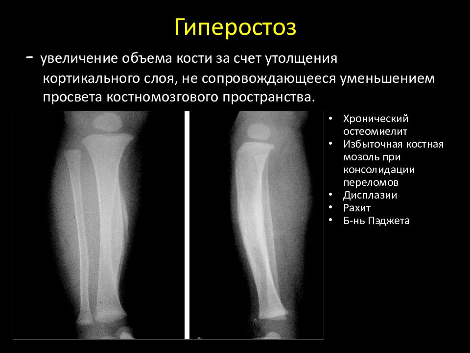 Рост кости за счет. Гиперостоз плечевой кости рентген. Гиперостоз коленный сустав рентген. Гиперостоз пяточной кости рентген. Утолщение кортикального слоя большеберцовой кости рентген.