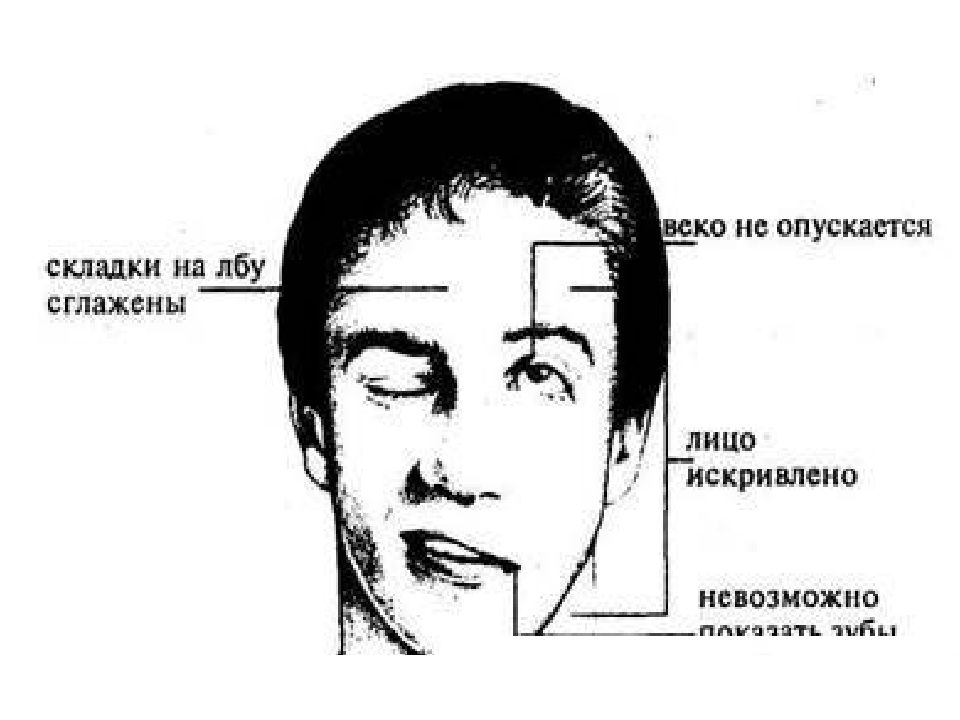Опускать лоб. Инсульт парез лицевого нерва. Симптомы Россолимо Мелькерссона Розенталя. Неврит лицевого нерва.