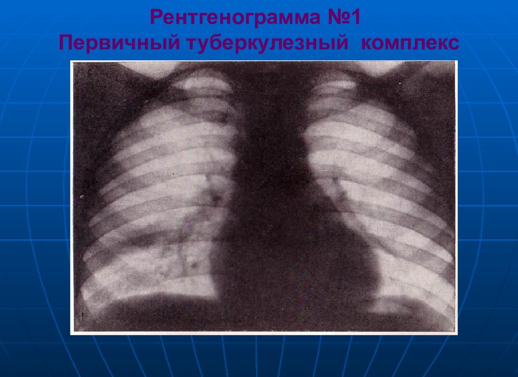 Первичный туберкулезный комплекс. Первичный туберкулезный комплекс петрификация. Первичный туберкулезный комплекс очаг гона. Первичный туберкулез рентген. Первичный туберкулезный комплекс рентген.