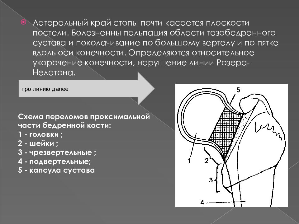 Импрессионный головки кости. Латеральный перелом бедренной кости. Плоскости тазобедренного сустава. Укорочение бедренной кости. Перелом бедра пальпация.