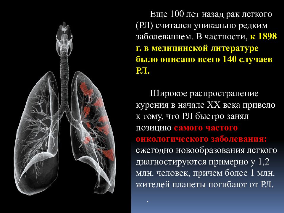 Рак легкого симптомы сколько живут. Опухоли органов дыхания. Раковые заболевания легких. Онкология органов дыхания. - Раковые заболевания лёгких.