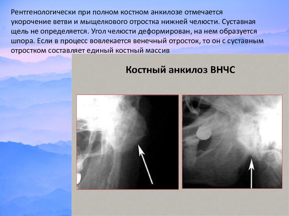 Анкилоз внчс презентация