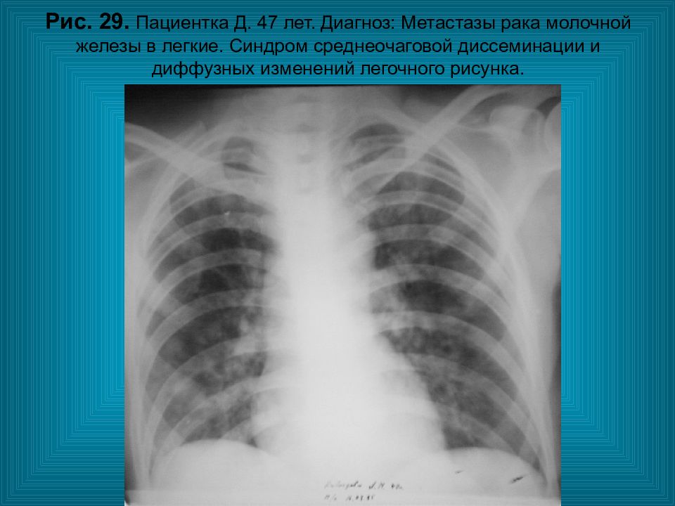 Диффузное изменение легочного рисунка