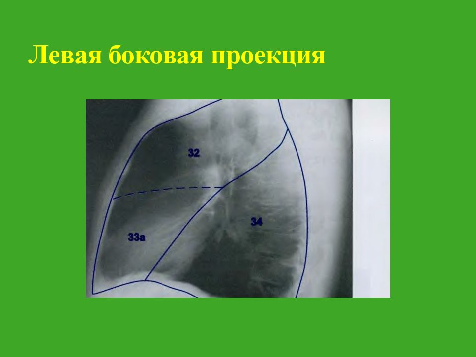 Прямая и боковая проекция. Левая боковая проекция. Легкие в боковой проекции. Левая боковая проекция легких. Левая боковая проекция легких на рентгене.