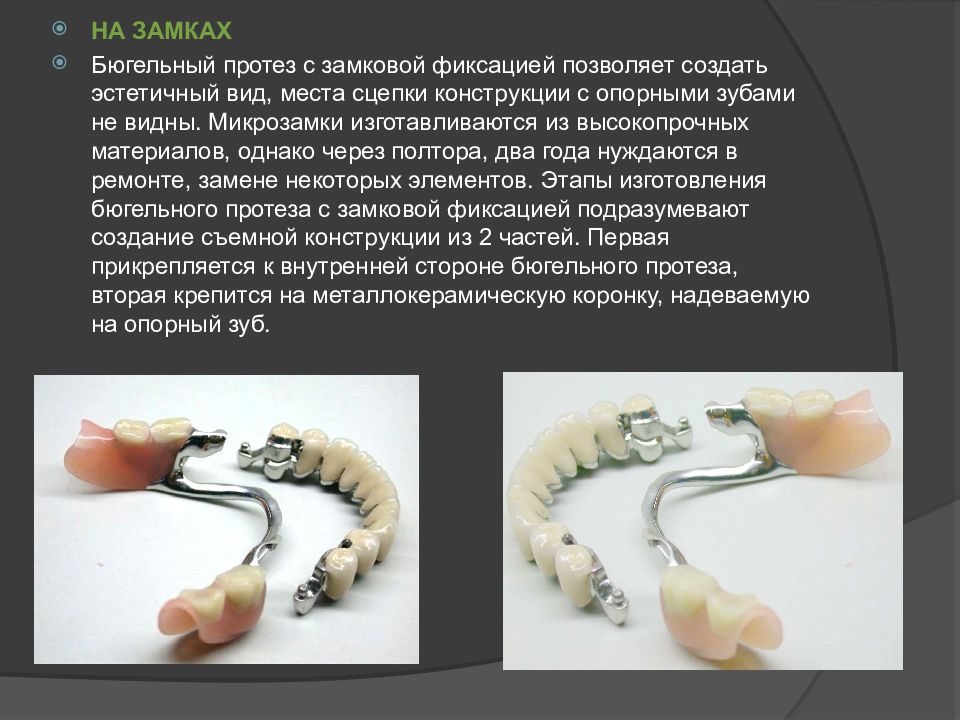 Этапы изготовления бюгельных протезов презентация