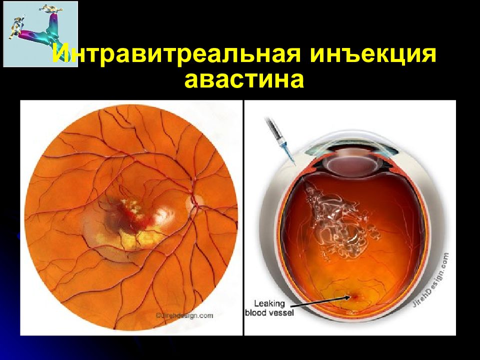 Возрастная макулярная дегенерация презентация