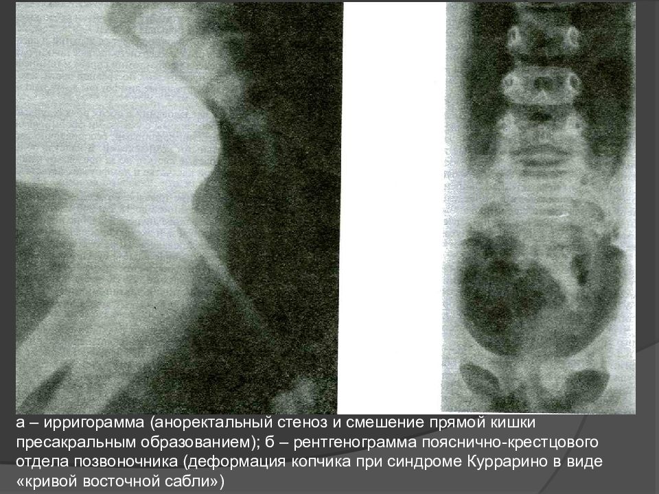 Спинномозговые грыжи презентация